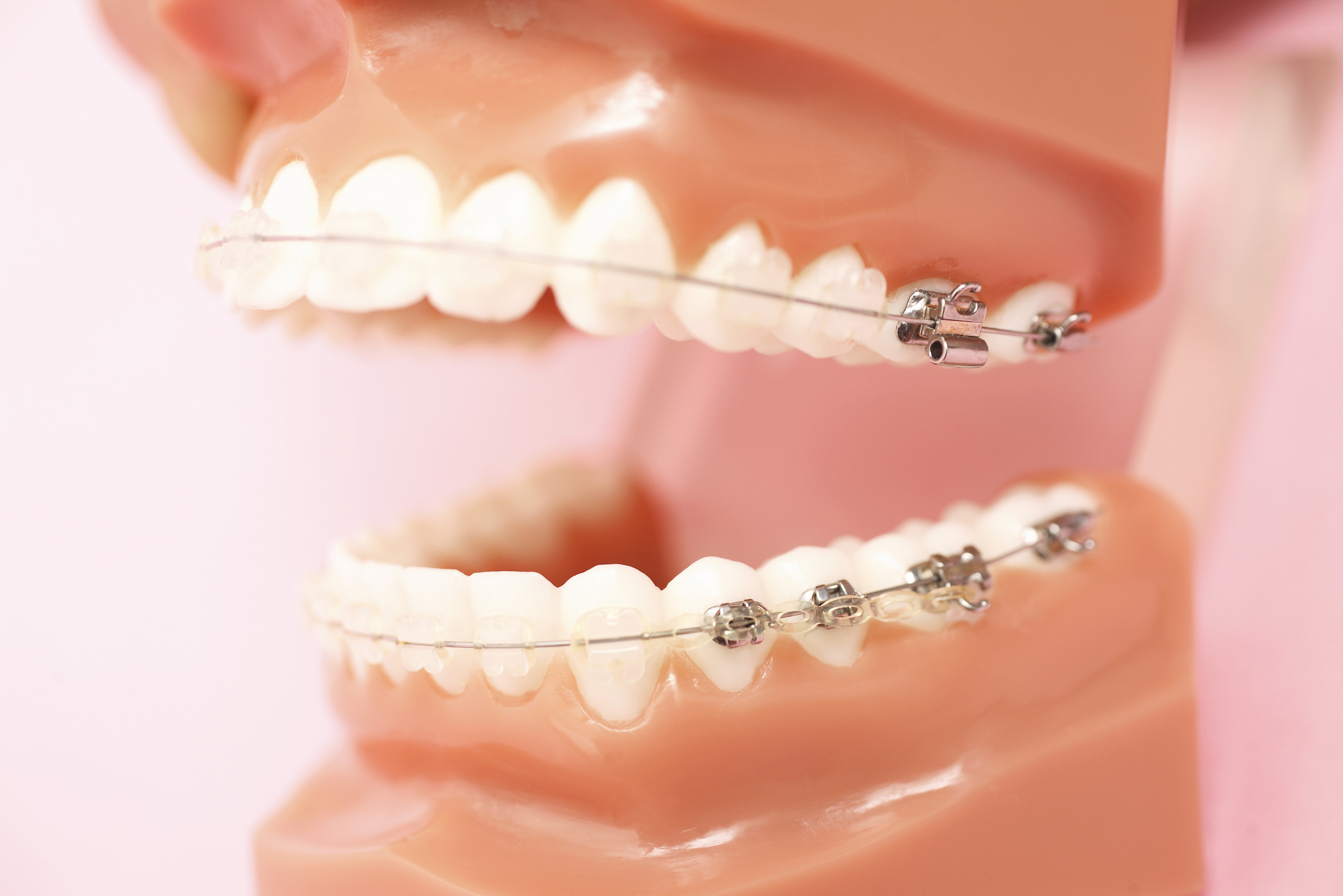 ②局部的な歯の矯正方法​